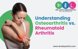 Osteoarthritis vs. Rheumatoid Arthritis