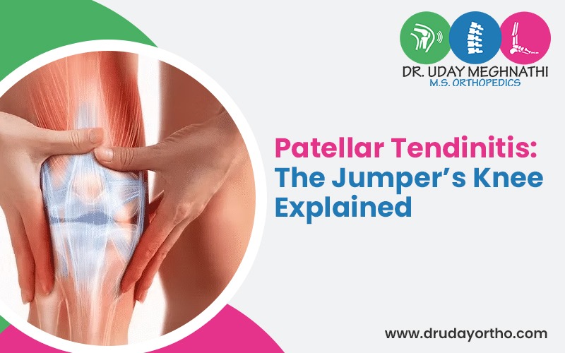 Patellar Tendinitis with Dr. Uday