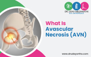 Avascular Necrosis