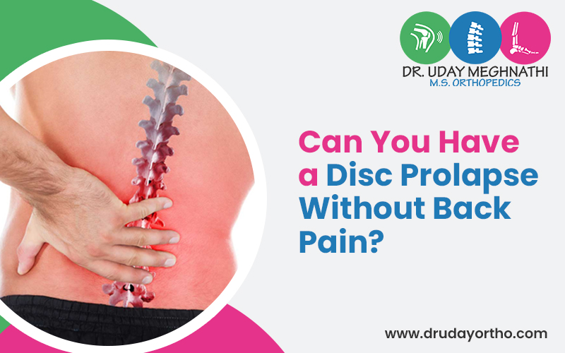 Disc Prolapse Without back Pain