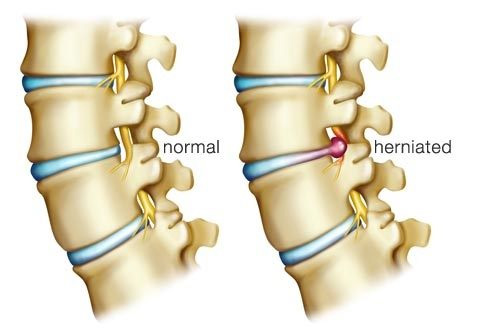 Disc Prolapse Without Back Pain