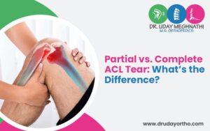 ACL Tear Types Partial vs. Complete Injury Guide