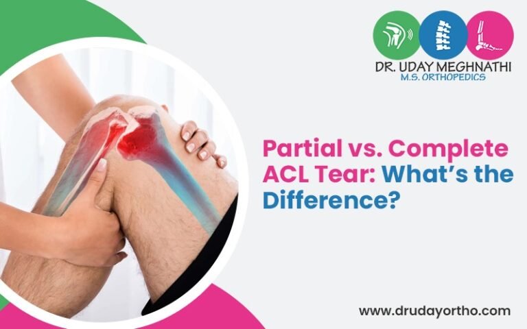 Sl Partial Rupture ACL Tear Types: Partial vs. Complete Injury Guide