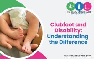 Clubfoot in Newborn