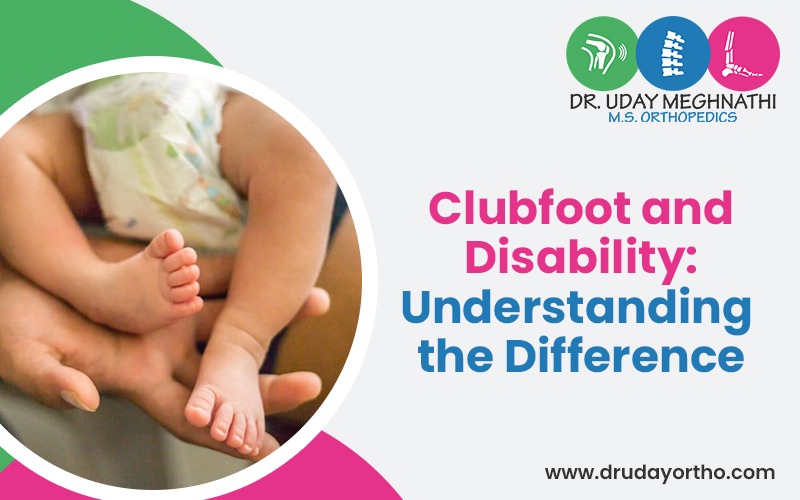 Clubfoot in Newborn