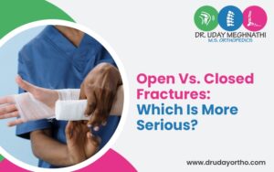 Open vs. Closed Fractures