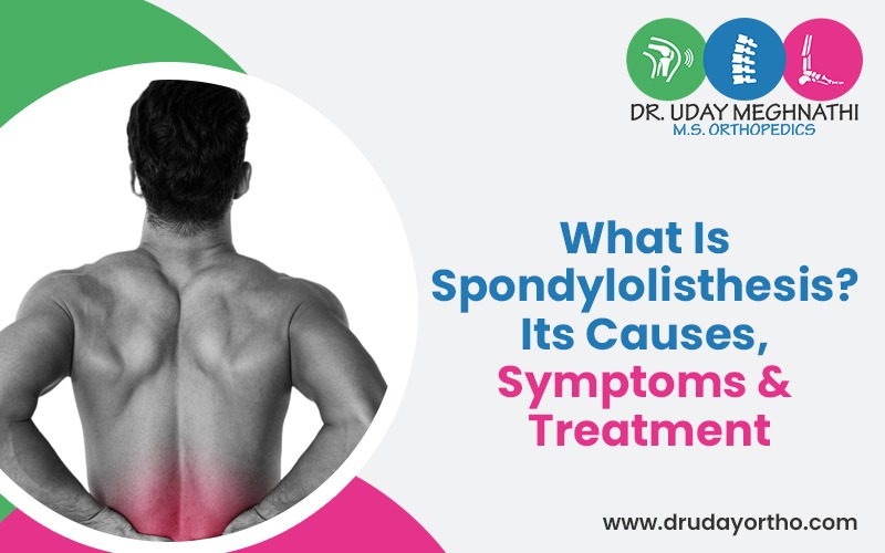 What is Spondylolisthesis