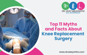 Top 11 Myths and Facts About Knee Replacement Surgery