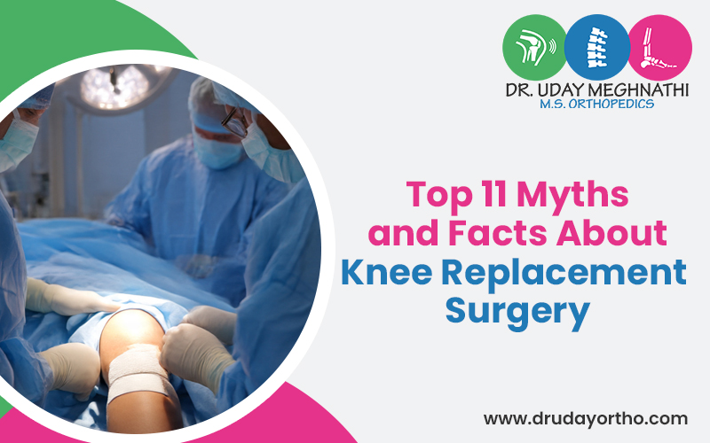 Top 11 Myths and Facts About Knee Replacement Surgery
