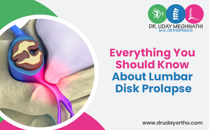 What is Lumbar Disk Prolapse
