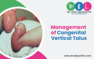 Management of Congenital Vertical Talus
