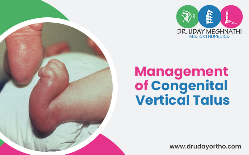 Management of Congenital Vertical Talus